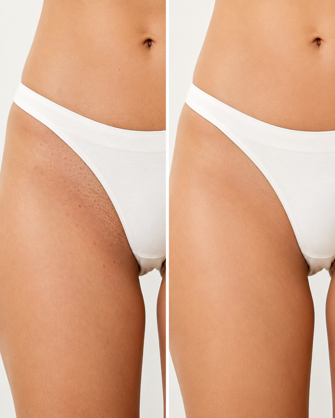 Laser bikini Antwerpen: langdurige ontharing van de bikinilijn bij Diodella